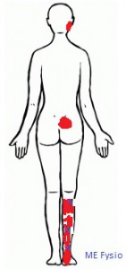 referred pain soleus uitstralingsgebied