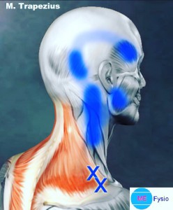 Trapezius uitstralende pijn